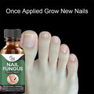 Nail Fungus Treatment Stop Fungal Growth Effective Fingernail 10ml