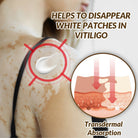 Sumifun Vitiligo Care Cream 30ml | Pigmentation Care Cream | Botanical Skin Care Formula | Daily Skin Care | External Use