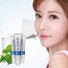 Bio Aqua Acne Cream Face Skin Care Acne Anti-Wrinkle Removal Cream Spots Scar Blemish Marks 30g