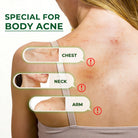 Sumifun Body Acne Care Spray 100ml | Tea Tree Body Spray | Back, Chest & Shoulder Skin Care Spray | Daily Body Care Formula