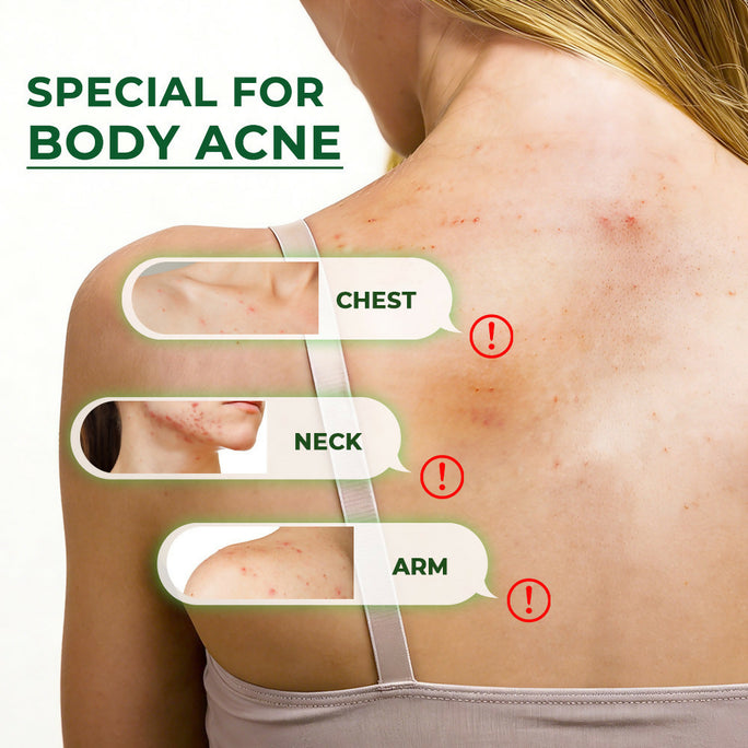Sumifun Body Acne Care Spray 100ml | Tea Tree Body Spray | Back, Chest & Shoulder Skin Care Spray | Daily Body Care Formula
