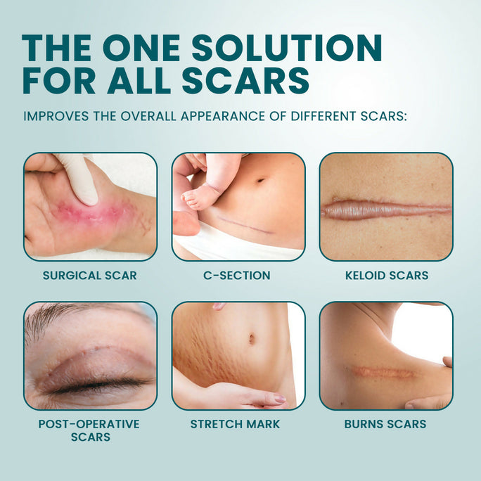 Sumifun Silicone Scar Cream 30g | Scar Care Cream | Moisturizing Skin Care Cream for Face & Body | Silicone Gel Formula